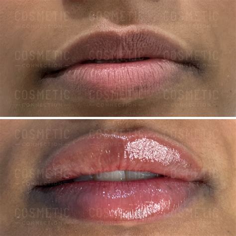 1mil lip filler|Understanding 1ml Lip Filler Impact